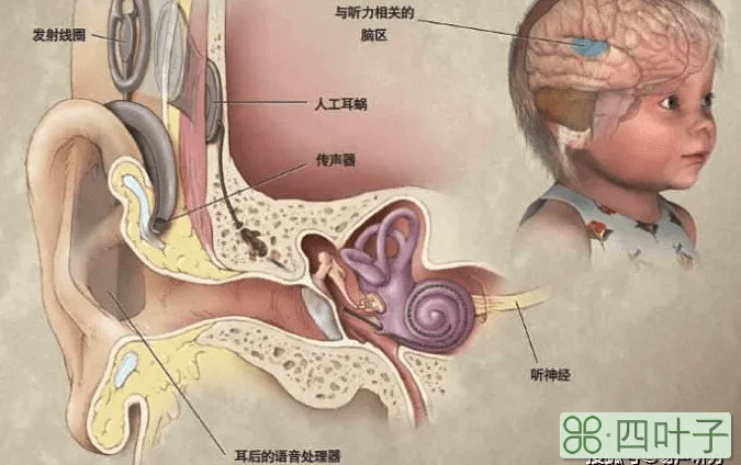 一些听损孩子为何是“蓝眼睛”