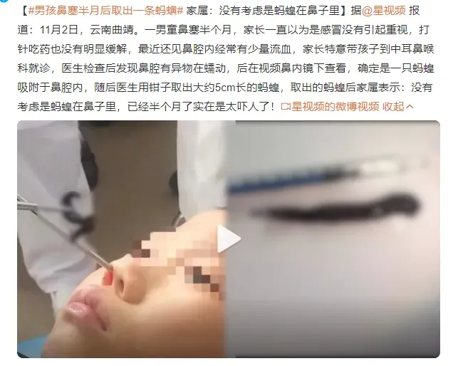 男孩鼻塞半月后取出一条蚂蟥 网友：鸡皮疙瘩都起来了