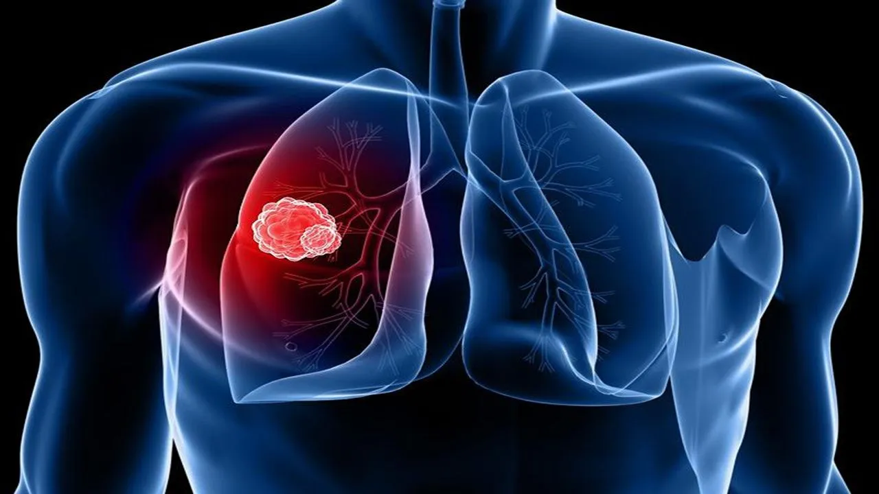 肺癌的15个征兆 肺癌的15个征兆是什么