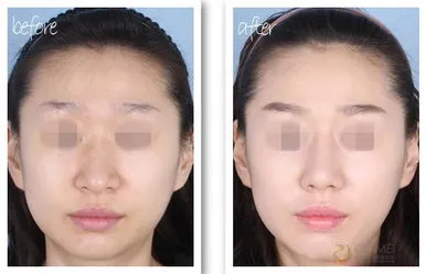 隆鼻手术需多少费用,北京韩式隆鼻手术费用是多少