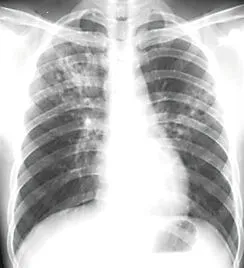 肺结核是由什么原因引起的,难以治愈的肺结核，究竟是什么原因？