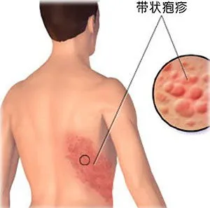 超90%成人体内潜伏带状疱疹,带状疱疹怎么预防？专家：对于老年人，预防接种尤为必要