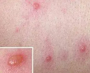 带状性疱疹是水痘吗?