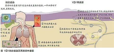 带状疱疹一般多少岁容易发病