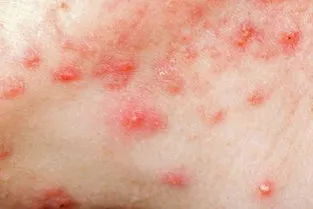 水痘是皮肤病吗
