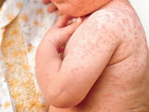 典型麻疹的出疹顺序是,郭俊田医案：麻疹的防治二，麻疹的诊断