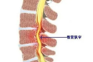 椎管狭窄的最佳治疗方法,椎管狭窄 治疗椎管狭窄的方法有哪些