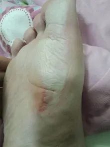 脚心捂出来白色的点,手上、脚上长这种硬硬的疣，具有一定的传染性，最好采用保守治疗