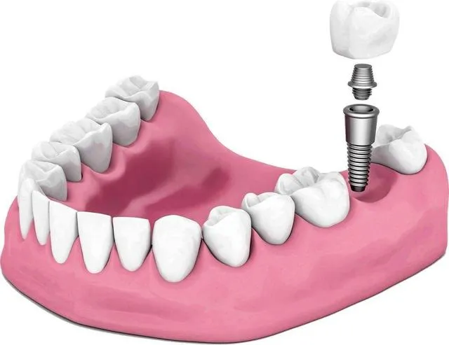 种植牙万元时代即将结束 种植牙以后会越来越便宜么?