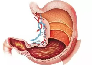 胃癌是什么原因引起的 胃癌是什么原因引起的病